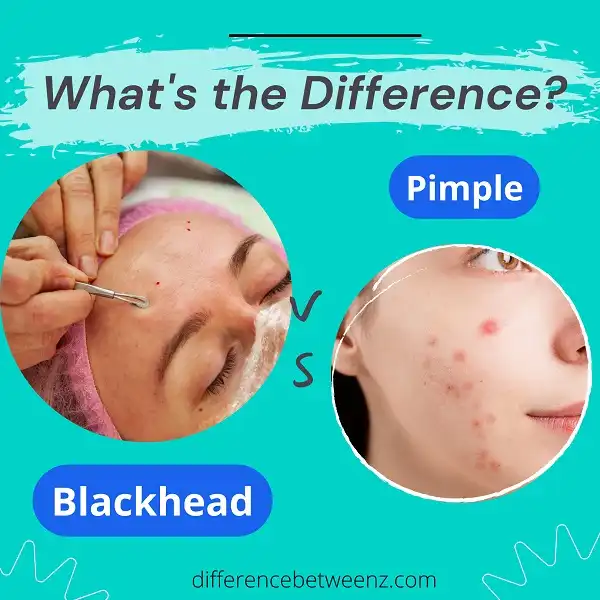 Difference between Blackhead and a Pimple