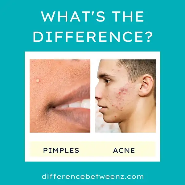 Difference between Pimples and Acne