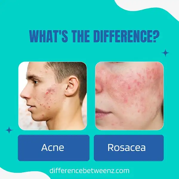 Difference between Acne and Rosacea