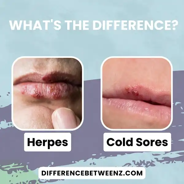 Difference between Herpes and Cold Sores