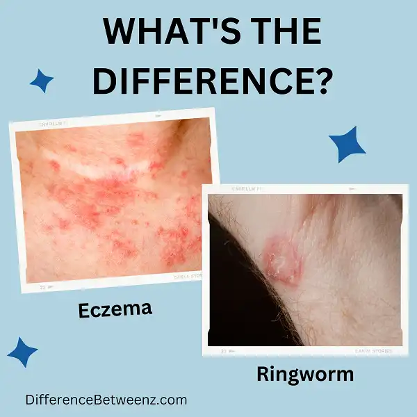 Difference between Eczema and Ringworm