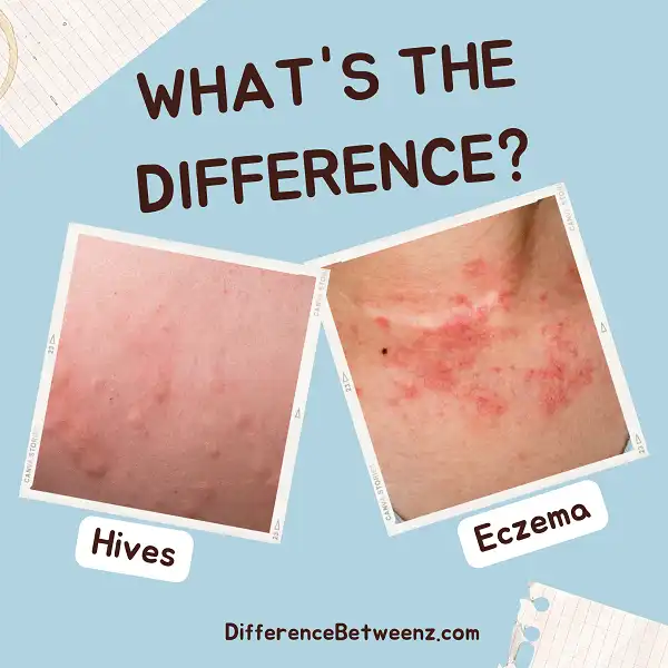 Difference between Hives and Eczema