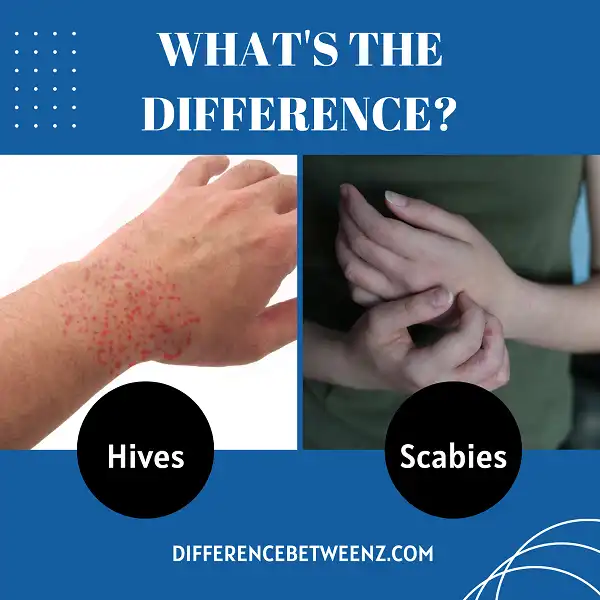 Difference between Hives and Scabies