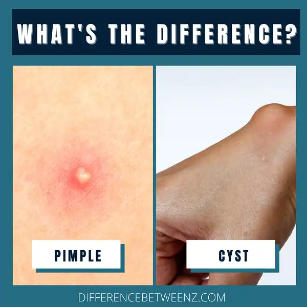 Difference between Pimple and Cyst