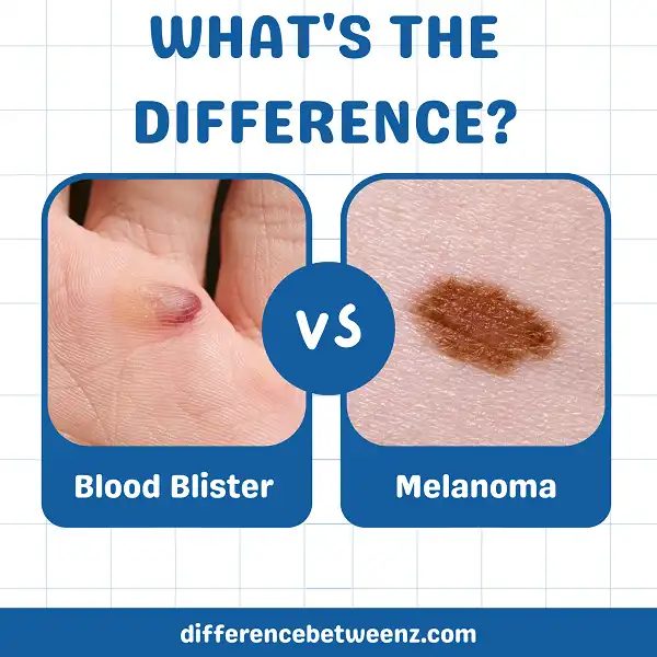 Difference between Blood Blister and Melanoma